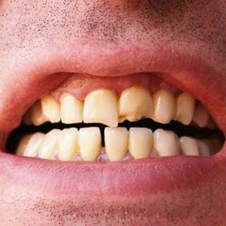 تصدع الأسنان تصدع الأسنان