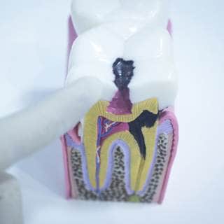 تسوس الأسنان تسوس الأسنان