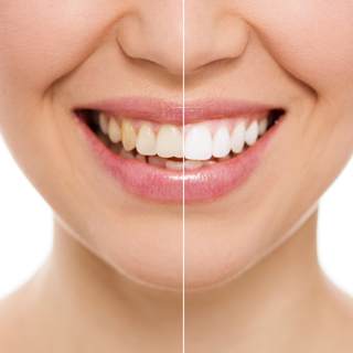 تنظيف الاسنان وتبيضها تنظيف الاسنان وتبيضها