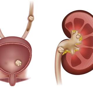 حصى الكلى حصى الكلى