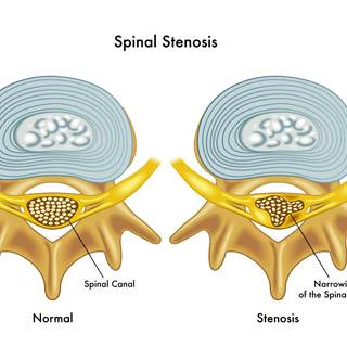 تضيق العمود الفقري تضيق العمود الفقري