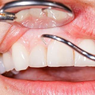 ما هي اسباب الاصابة بامراض اللثة؟ ما هي اسباب الاصابة بامراض اللثة؟