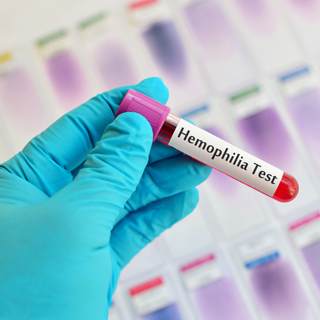 تشخيص الهيموفيليا تشخيص الهيموفيليا