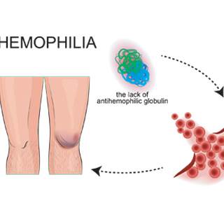 ما هي مضاعفات الهيموفيليا؟ ما هي مضاعفات الهيموفيليا؟