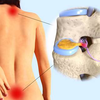 القرص الغضروفي (Herniated disk) القرص الغضروفي (Herniated disk)