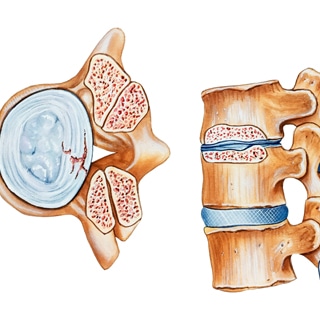 تضيق في العمود الفقري تضيق في العمود الفقري