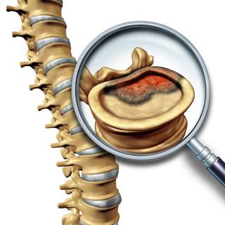 ورم في العمود الفقري ورم في العمود الفقري