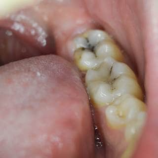 تسوس الاسنان تسوس الاسنان