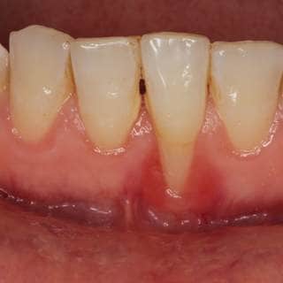 مشاكل اللثة مشاكل اللثة