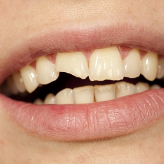 تكسر الأسنان تكسر الأسنان