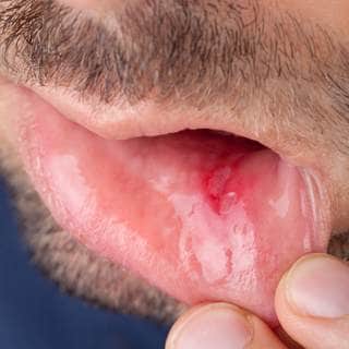 القروح القروح