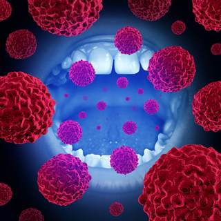 سرطان الفم سرطان الفم