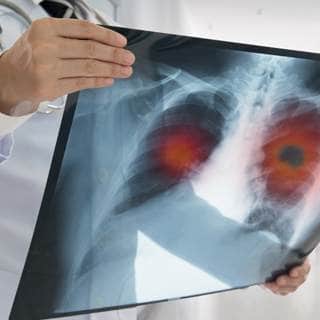 تشخيص سرطان الرئة تشخيص سرطان الرئة