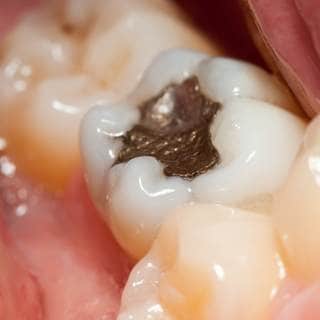 حشوات الأسنان حشوات الأسنان