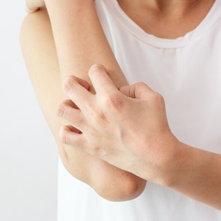 الحكة الحكة