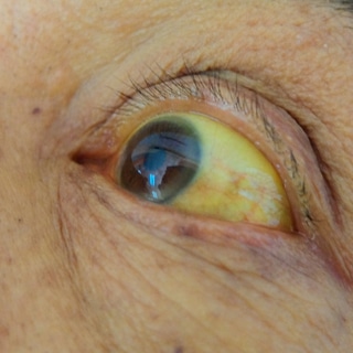 أعراض سرطان القنوات الصفراوية أعراض سرطان القنوات الصفراوية