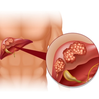 سرطان الكبد وتليف الكبد سرطان الكبد وتليف الكبد