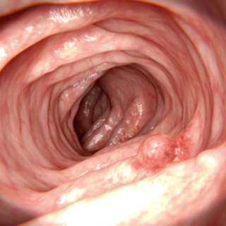 ما هي الأورام الحميدة؟ ما هي الأورام الحميدة؟