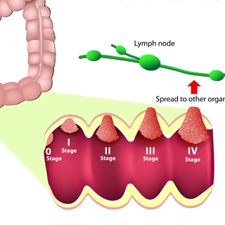 مراحل سرطان القولون والمستقيم مراحل سرطان القولون والمستقيم