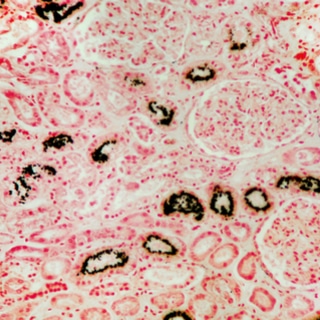 تكلس الكلى تكلس الكلى