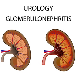 التهاب كبيبات الكلى التهاب كبيبات الكلى