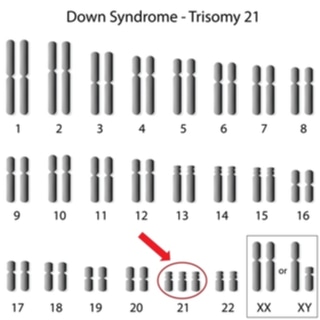 متلازمة داون هي مشكلة في الجينات، ولكنها ليست وراثية متلازمة داون هي مشكلة في الجينات، ولكنها ليست وراثية