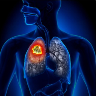 تقي من السرطان تقي من السرطان