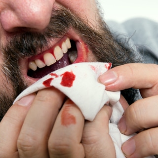 نزيف اللثة نزيف اللثة