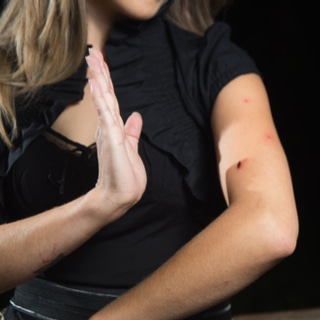 لدغات البعوض لدغات البعوض