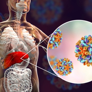 التهاب الكبد الفيروسي التهاب الكبد الفيروسي