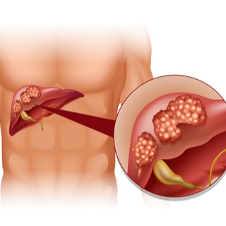 سرطان الكبد سرطان الكبد
