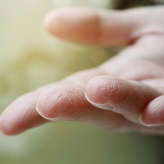 الجلد الجاف