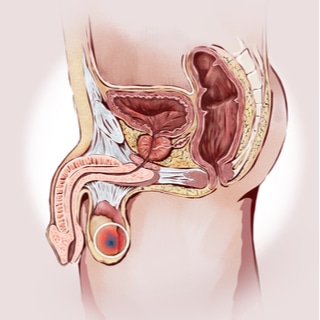 سرطان الخصية سرطان الخصية