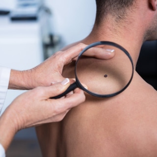 سرطان الجلد سرطان الجلد