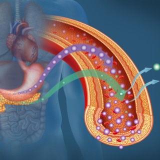 سكّري النوع الثاني حالة مزمنة