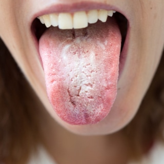 البقع البيضاء البقع البيضاء