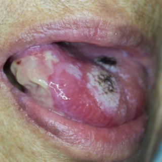 علامات سرطان الفم علامات سرطان الفم