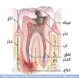 لماذا قد تحتاج إلى علاج نفق الجذر لماذا قد تحتاج إلى علاج نفق الجذر