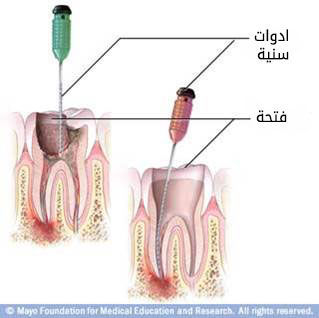 بداية علاج نفق الجذر بداية علاج نفق الجذر