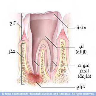 إزالة الملوثات من نفق الجذر إزالة الملوثات من نفق الجذر