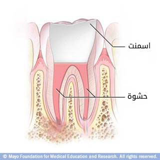 حشو قنوات الجذر حشو قنوات الجذر