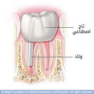 المرحلة النهائية من علاج نفق الجذر المرحلة النهائية من علاج نفق الجذر