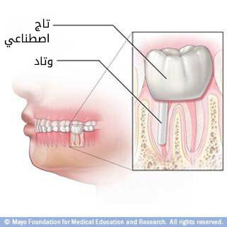 بعد علاج نفق الجذر بعد علاج نفق الجذر