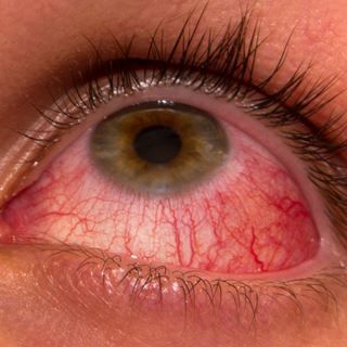 الالم المفاجئ في العينين، الاحمرار، الغثيان والقيء. الالم المفاجئ في العينين، الاحمرار، الغثيان والقيء.