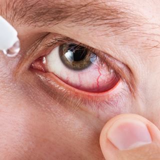 حرقة العينين، الشعور بالحكة، الدموع والالم على سطح العين. حرقة العينين، الشعور بالحكة، الدموع والالم على سطح العين.