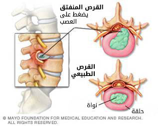 إنفتاق القرص إنفتاق القرص