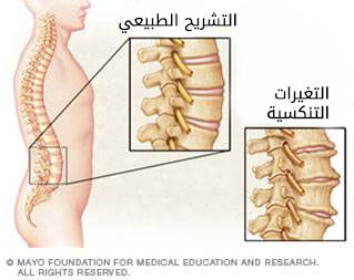 التغيرات التنكسية في العمود الفقري التغيرات التنكسية في العمود الفقري