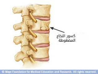 هشاشة العظام هشاشة العظام