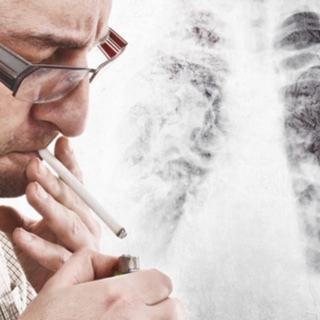 اسباب سرطان الرئة اسباب سرطان الرئة