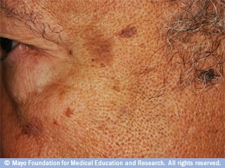 اضرار تلحق بالبشرة الداكنة اضرار تلحق بالبشرة الداكنة